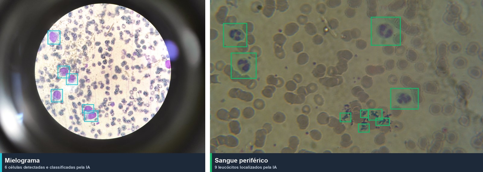 Detecções da IA: células marcadas em campos de mielograma e sangue periférico